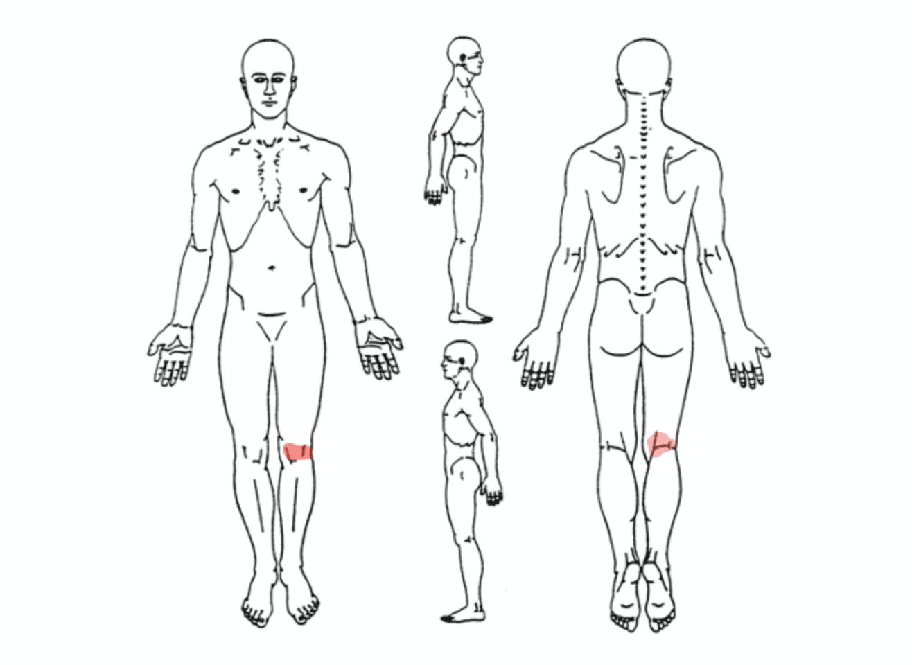 ACL断裂チャート