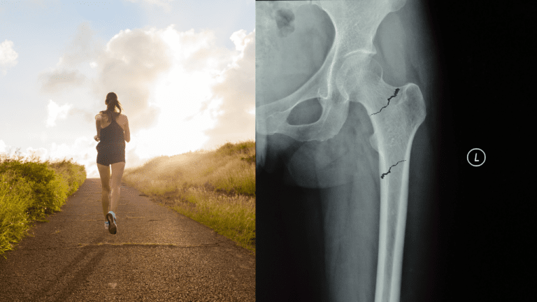 Ikke gå glipp av femoral stressfrakturer hos den kvinnelige løperen
