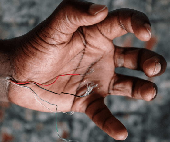 Fisioterapia Jesson para a dor radicular