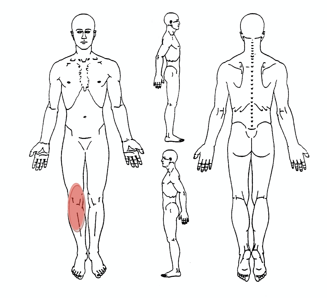 مخطط ألم PFPS