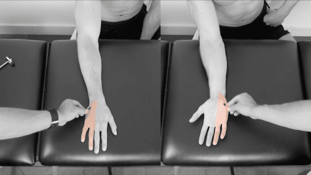 Dermatomes Upper Limb