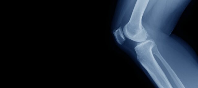 fuerza del cuádriceps en el cartílago de la rodilla