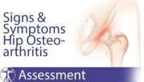 Hip osteoarthritis diagnosis