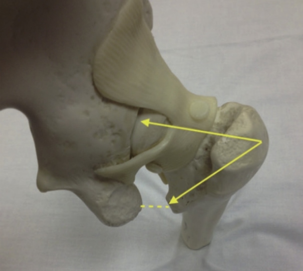 Ischiofemoral Impingement Test Ischiofemoral Hip Impingement Ischiofemoral Impingement Test Ischiofemoral Hip Impingement