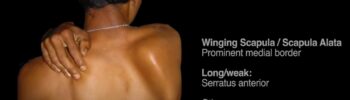 Scapular alignment