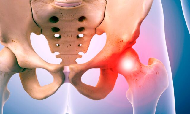 Femoroasetabular Sıkışma FAI