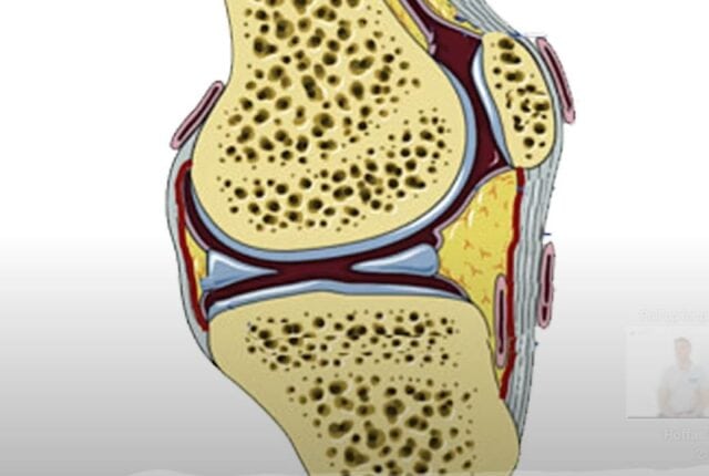 Syndrome du coussinet adipeux infra-patellaire