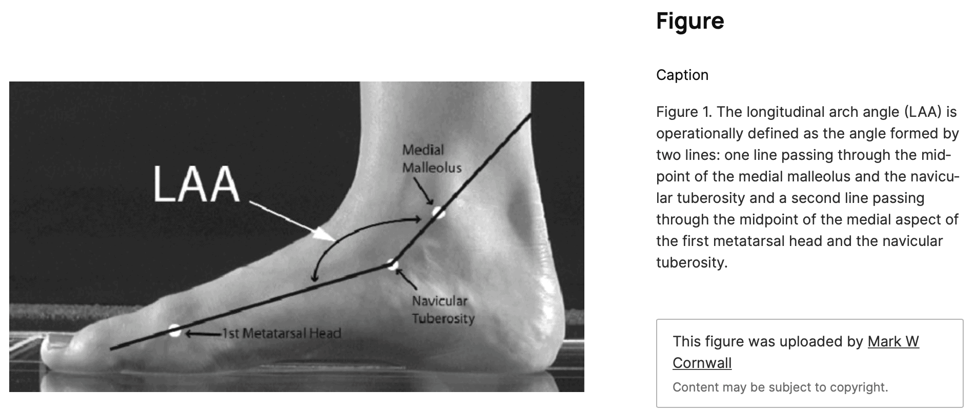 exercise program to correct a reversible flatfoot