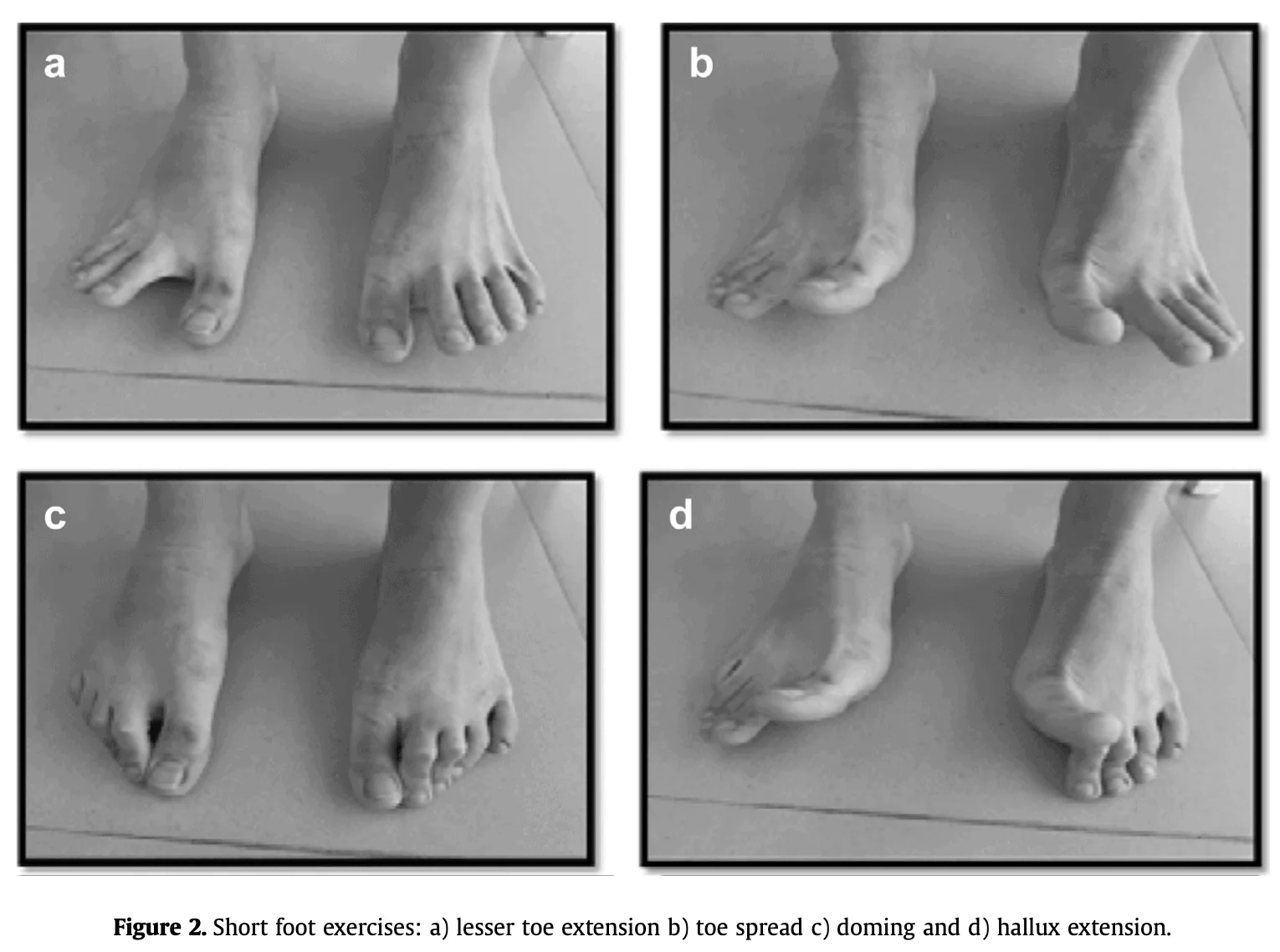 exercise program to correct a reversible flatfoot