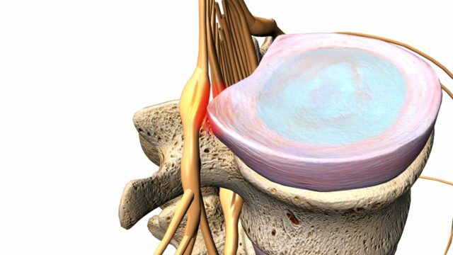 Síndrome Radicular Lumbar