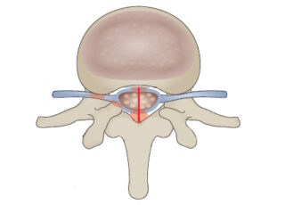 Lumbar spinal stenosis featured image