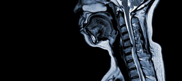 Mielopatía cervical espondilótica