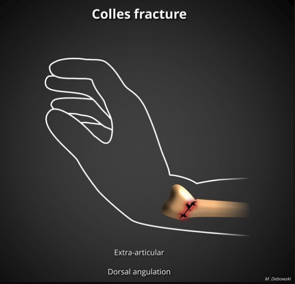 fratura de Colles