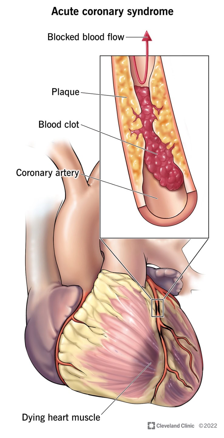 syndrome coronarien aigu