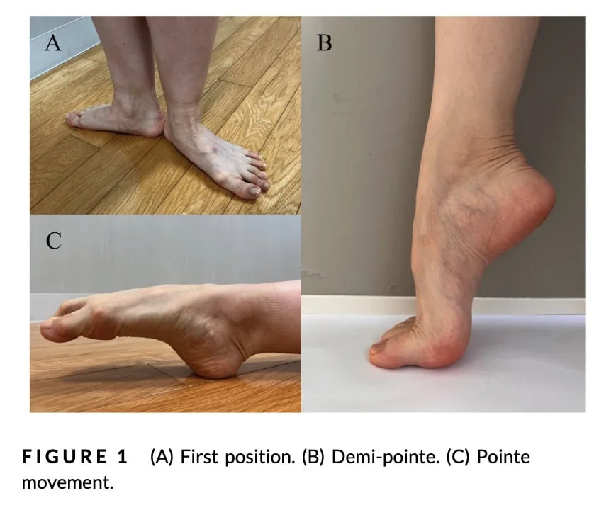 hallux valgus tanssijoilla