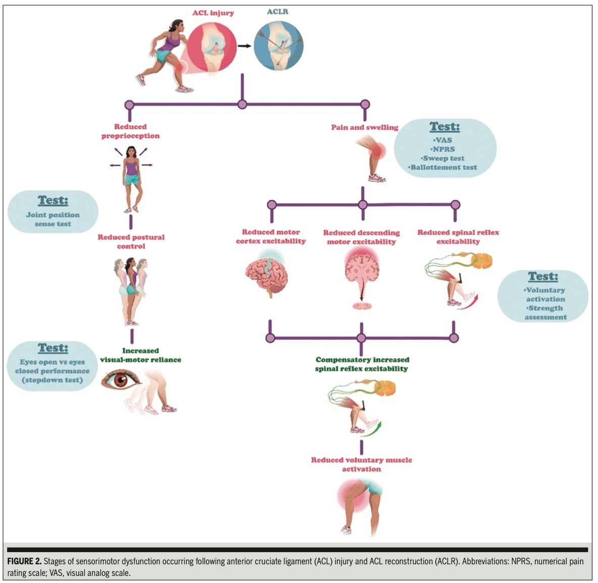 前交叉韧带损伤后的感觉运动功能障碍
