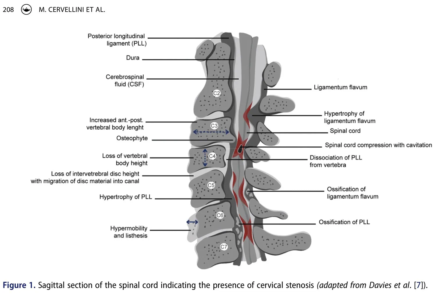 myélopathie cervicale dégénérative