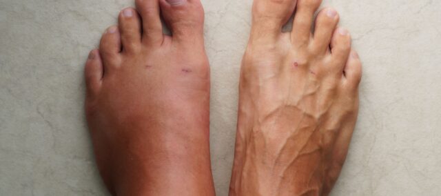 Revalidatie-interventies voor crps (1)