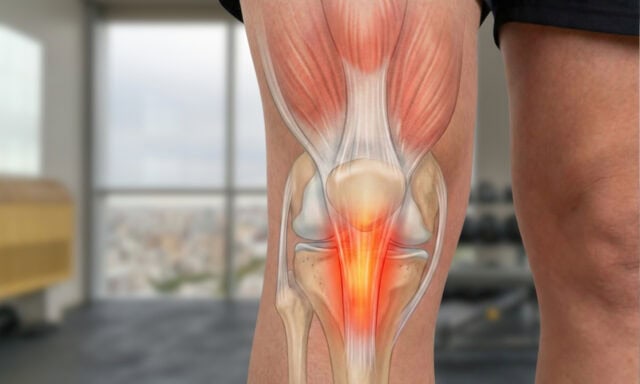Tendinopathie rotulienne