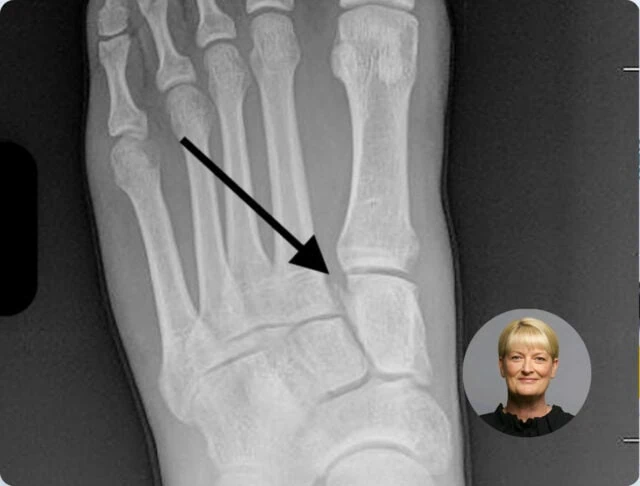 Lisfranc Joint Complex Injury in Sport