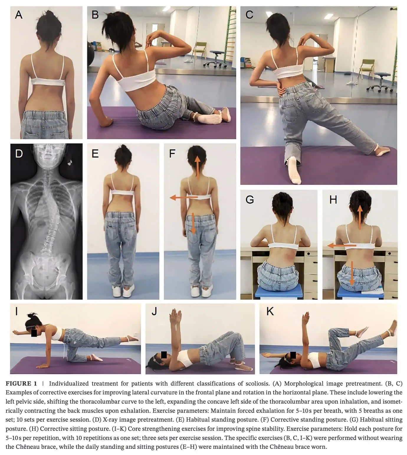 Optimizing Bracing Outcomes in Adolescent Idiopathic Scoliosis