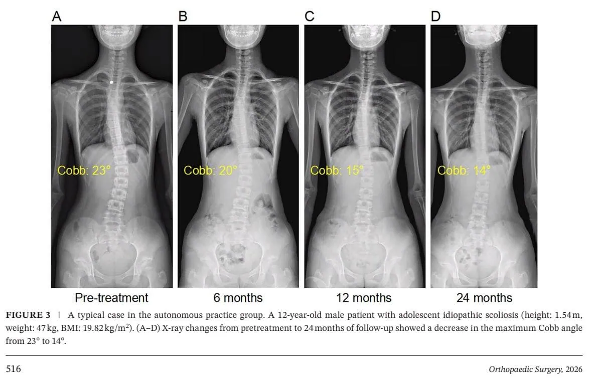Optimizing Bracing Outcomes in Adolescent Idiopathic Scoliosis