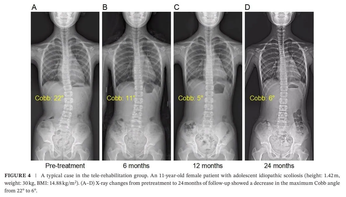 Optimizing Bracing Outcomes in Adolescent Idiopathic Scoliosis
