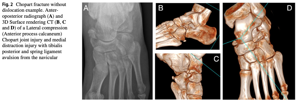 Chopart Injuries: A Key Differential Diagnosis Not to Miss in Physiotherapy Practice - Highlights on Diagnosis and Management