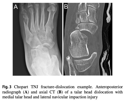 Chopart Injuries: A Key Differential Diagnosis Not to Miss in Physiotherapy Practice - Highlights on Diagnosis and Management